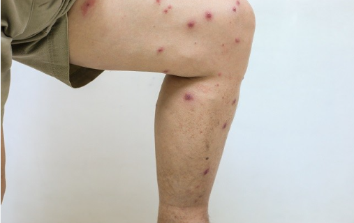 Kematian Akibat Lalat Pasir Leishmaniasis Picu Kewaspadaan di Thailand
